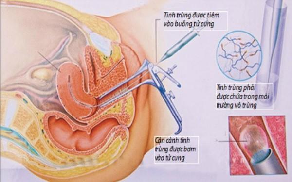 Chuyện hy hữu: Cặp song sinh không cùng cha cũng không cùng mẹ - 1