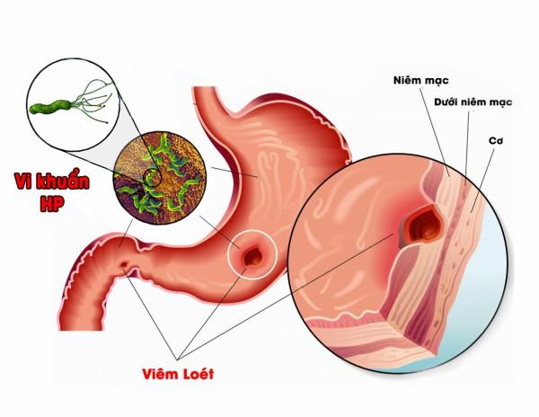 13 lý do bạn nên giảm lượng muối trong bữa ăn - 4