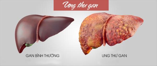  34 tuổi bị chẩn đoán ung thư gan, ‘thủ phạm’ hóa ra chính là người vợ của anh - 1