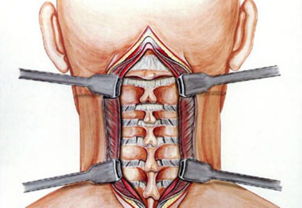 Bẻ cổ, lắc cổ kêu răng rắc gây nguy hiểm như thế nào cho bạn? - 1