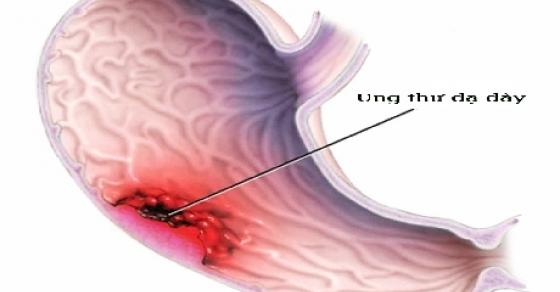 Chướng bụng, nôn ra máu – Dấu hiệu cảnh báo sớm ung thư dạ dày