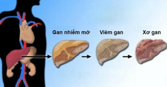 147 Content Xuat Hien 4 Dau Hieu Cung Luc Bao Hieu Benh Xo Gan Giai Doan Cuoi Tapchihoaky Info 1