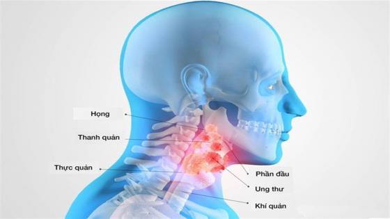 132 1 Nhung Dau Hieu De Nham Lan Cua Ung Thu Vom Hong